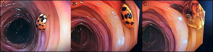 Ladybug in a human male colon.